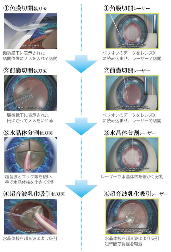 手術の流れ (通常白内障手術とレーザー白内障手術との比較)