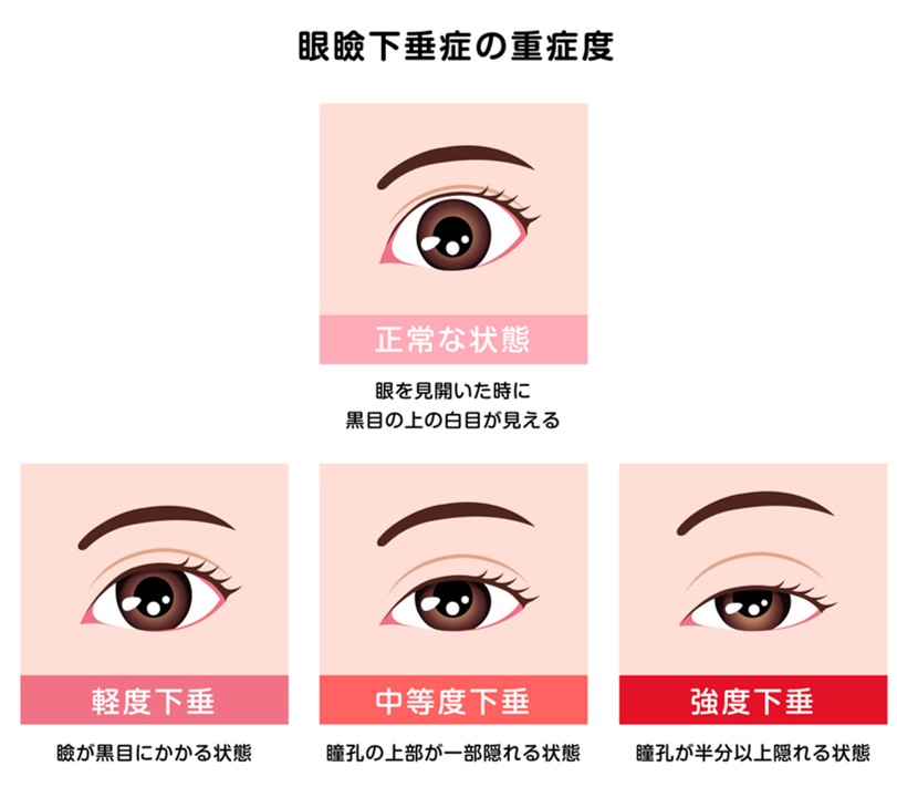 眼瞼下垂症の重症度 - 眼瞼下垂の治療・手術は東京都葛飾区の眼科・杉⽥眼科へ